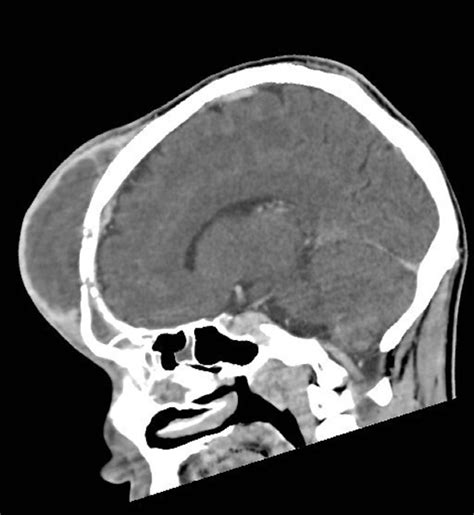 A huge Pott’s puffy tumour secondary to pansinusitis | BMJ Case Reports