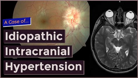 Idiopathic Intracranial Hypertension - MedEd Cases