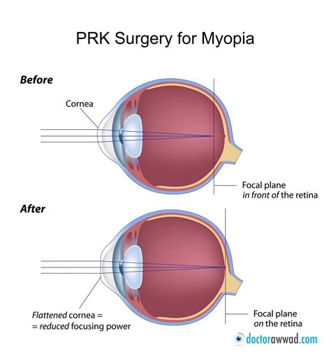 What Is Prk Eye Surgery