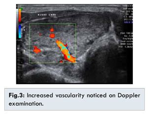 Thyroid Hemiagenesis: A Rare Finding