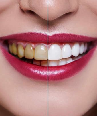 Dental Clinic in Nagpur | Best Dentist in Nagpur – Chandakdental