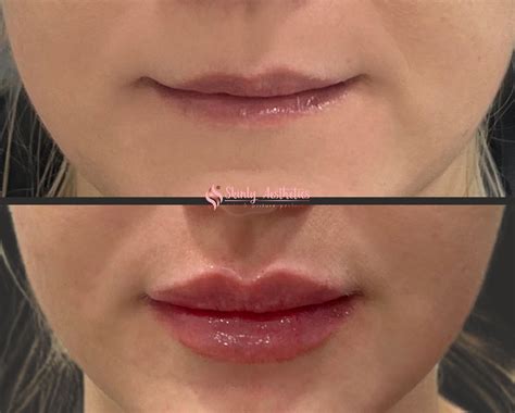 1 Syringe Lip Filler Before and After: Transformative Results
