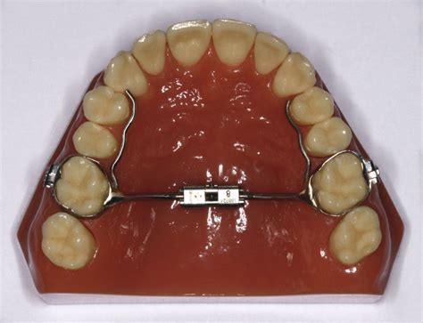 Palatal Expander Instructions by Williams Orthodontics - Orthodontist in Evergreen & Conifer CO