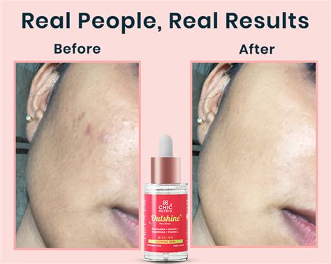 Chicnutrix Outshine Face Serum for Pigmentation, Dark Spots & Glow
