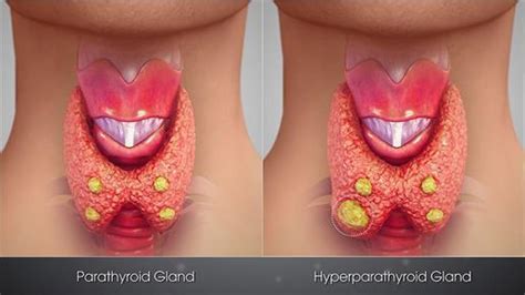 Parathyroid gland and Thymus — lesson. Science CBSE, Class 10.