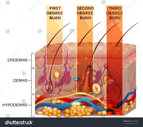 Second Degree Burn Care Plan at Juliane Michaelis blog