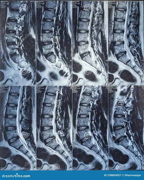 Magnetic Resonance Imaging or Mri Scan Report of Spinal Cord or Lumbar Bulging, X-ray, Lumbar ...