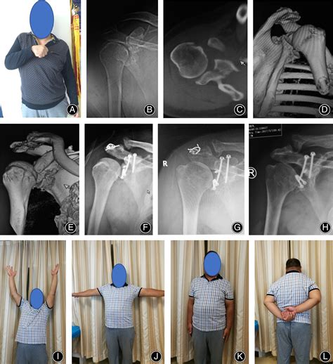 Treatment of Chronic Anterior Shoulder Dislocation by Coracoid ...