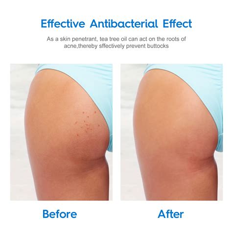 Pimples On Buttocks Crack