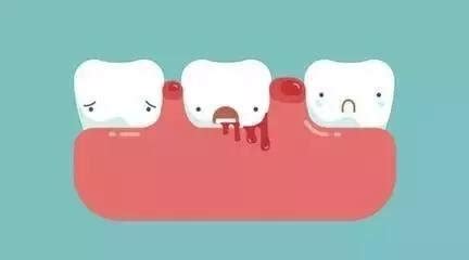 牙龈出血怎么预防和治疗-爱康健齿科