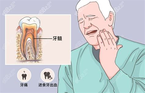 牙髓炎不疼了还需要治疗吗?需要,因为时间久了牙髓炎会恶化,专家提醒-8682赴韩整形网