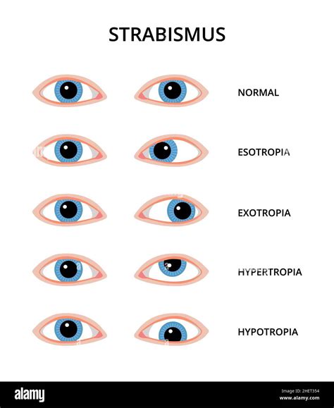 Strabismus esotropia hi-res stock photography and images - Alamy