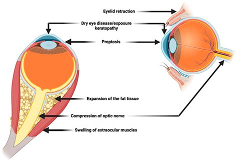 Thyroid Eye Disease: Advancements in Orbital and Ocular Pathology ...