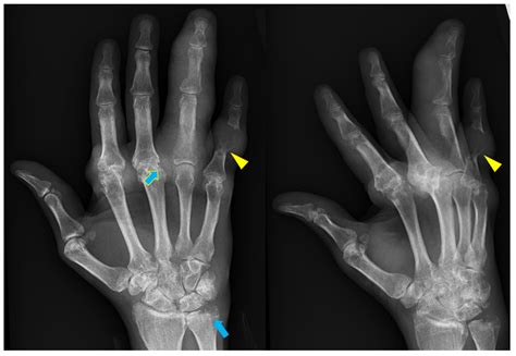 Rheumatoid Arthritis Hands X Ray