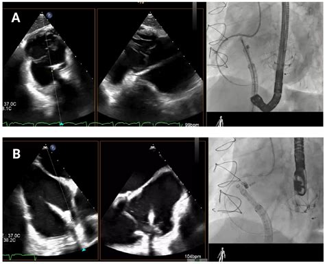 Transcatheter Tricuspid Valve Annuloplasty with the Cardioband System ...