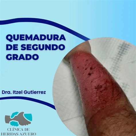 Cicatriz De Quemadura De Segundo Grado Semiología De Las Quemaduras
