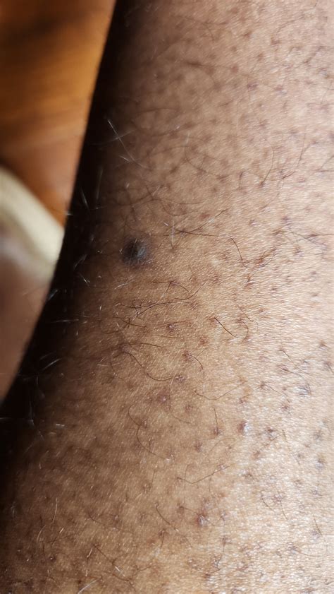 Possible treatment for dark spots on leg (dark skinned person) : r/30PlusSkinCare