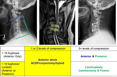 Acdf Medical Abbreviation