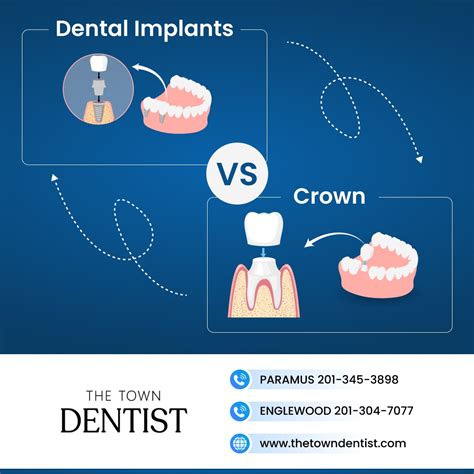 Dental Implants vs. Crowns: Detailed Comparison Analysis