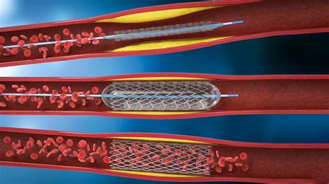 Stent Purpose Treatment Complications Recovery | OnlyMyHealth