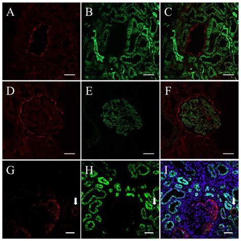 Evaluating the State of Glomerular Disease by Analyzing Urinary ...