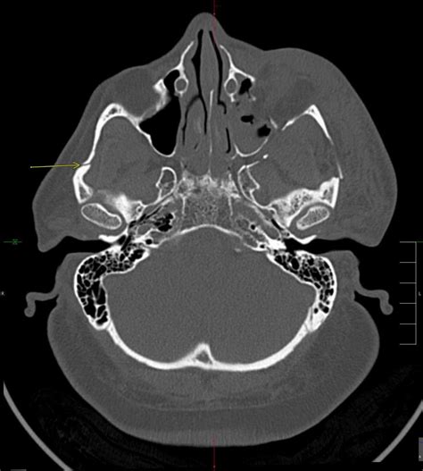 Le Fort III Fracture - MedEd Cases