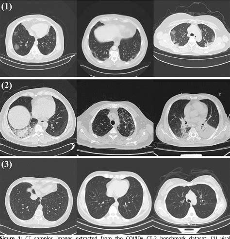 Figure 1 from Detection of Early Pneumonia on Individual CT Scans with Dilated Convolutions ...