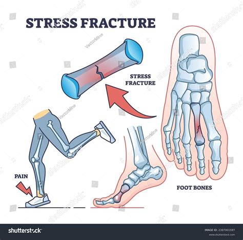 Stress Fracture Explanation Skeletal Foot Bone Stock Vector (Royalty ...