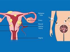 Image result for myomectomy