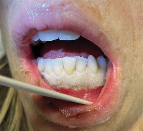 Gingival Infiltration in Acute Monocytic Leukemia List of - MEDizzy