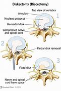 Image result for Discectomy