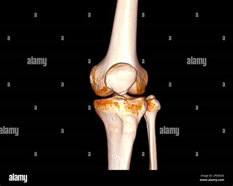 CT Scan of Knee joint 3D rendering Stock Photo - Alamy