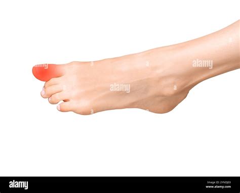 Big toe pain, joint ache, and inflammation. Sore foot with sprain, tendon bruise, and calcaneal ...