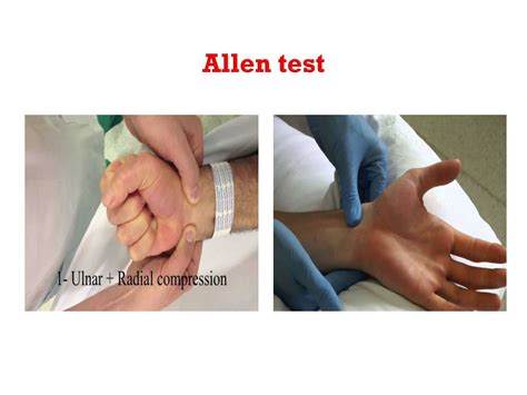 Allen Test Procedure at Douglas Nunez blog