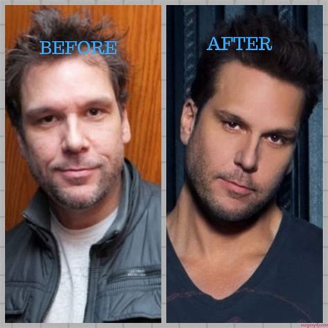 Dane Cook Plastic Surgery Photos [Before & After] - Surgery4