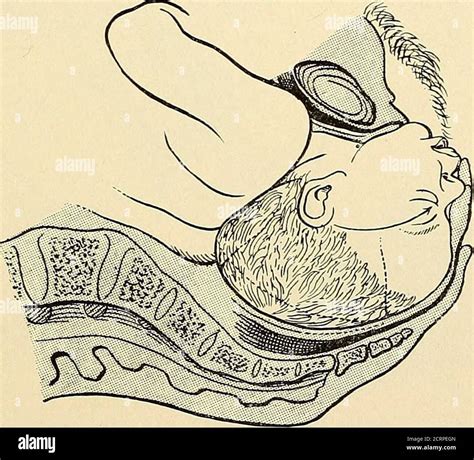 Face Presentation Mentum Posterior