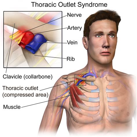 Thoracic Outlet Syndrome: An unheard of cause of arm DVT - Get Healthy ...