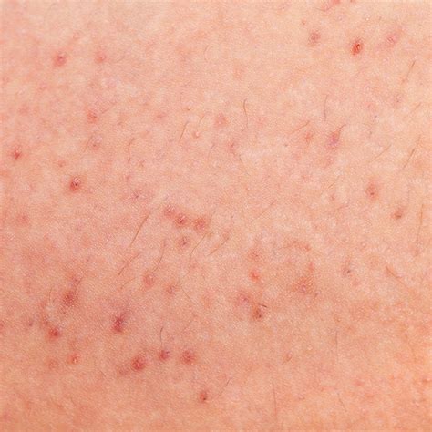 6 Ways to Prevent Razor Bumps When Shaving – RoseSkinCo.