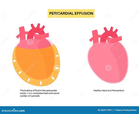 Pericardial Effusion Heart Cartoon Vector | CartoonDealer.com #280620605