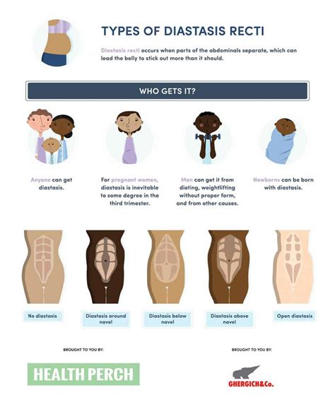 What You Can Do About Diastis Recti (Abdominal Separation) - PT & ME