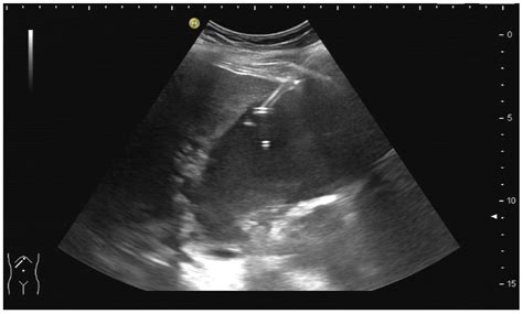 Ultrasound-Guided Interventions in the Biliary System