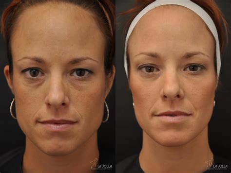 Sculptra® Before & After Gallery: Patient 20