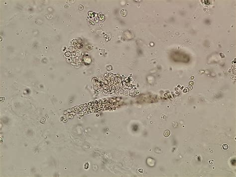 urinary cast Archives - Medical Notes