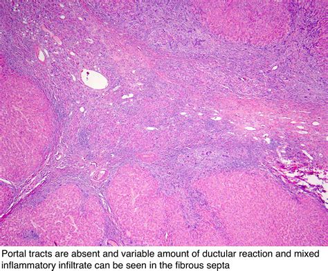 Focal Nodular Hyperplasia Liver