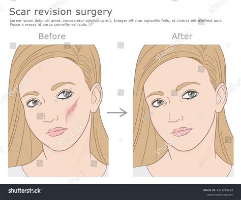 Scar Revision Surgery Vector Illustration Before Stock Vector (Royalty Free) 2517200293 ...