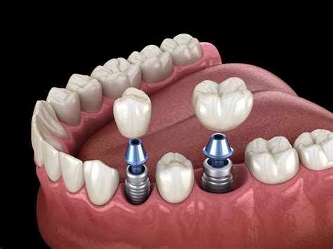 Defining Restorative Dentistry — and Why It’s So Important