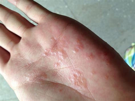 手指指尖处出现这样的水泡是什么病，不痛不痒，过几天长水泡的皮肤会变硬脱皮？有什么治疗方式？_百度知道