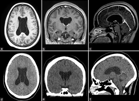 Cavum Septum Pellucidum