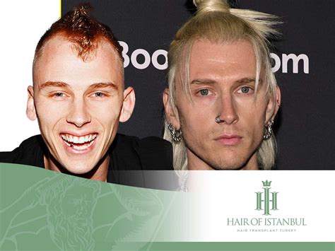 Machine Gun Kelly Hair Transplant: The Story Behind It