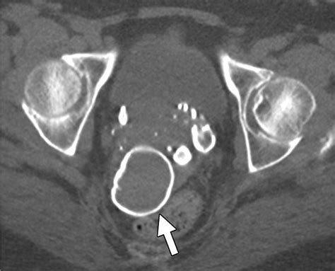 Diagnostic Approach to Benign and Malignant Calcifications in the Abdomen and PelvisRadioGraphics